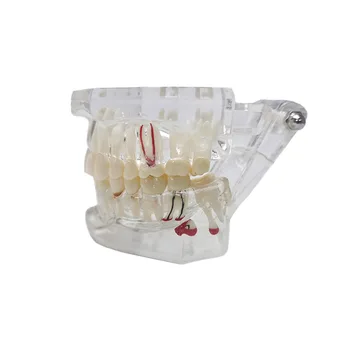 Dentare Transparente Dentare Model De Afișare De Plantare Unghiile Practică Pedagogică Modelul Medical Comunicarea Cu Pacientul